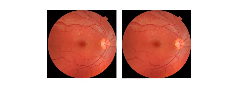 Angiographie numérique