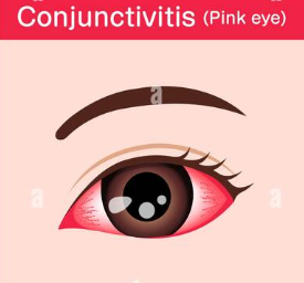 Occlusion Vasculaire