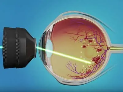 Chirurgie et laser des yeux : ce qu'il faut savoir