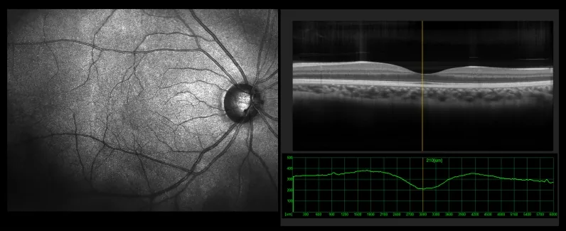 OCT de la macula pour le diagnostic de la DMLA