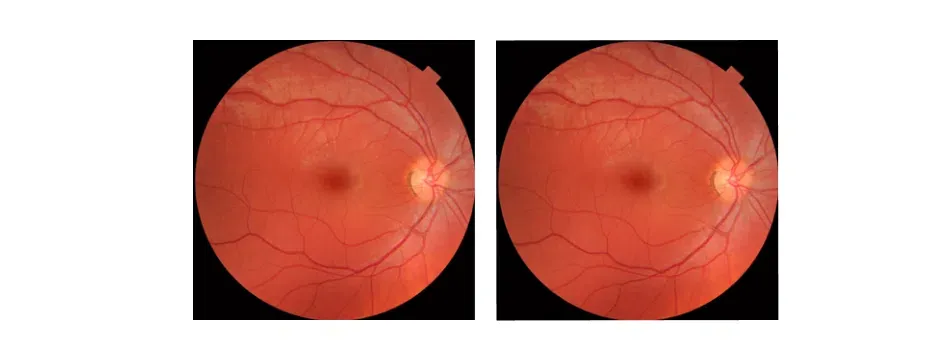 Diabète et yeux : pourquoi un fond d'œil chaque année est indispensable